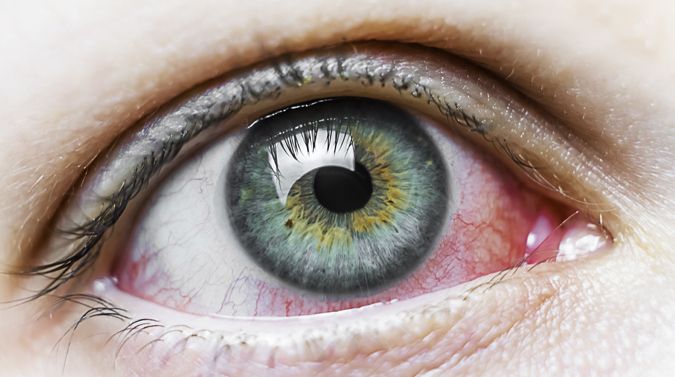 Blefaritis: Un tipo de ojo rojo indoloro